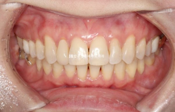 Can Invisalign Lite Work for Patients in Their 40s? A Real Case Improving Scissor Bite and Deep Bite in 10 Months image 13