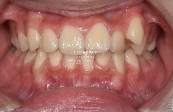 덧니 돌출입 발치교정 상악만 2개 편악 발치 클리피씨 입술부전증 치료 관련 이미지 2