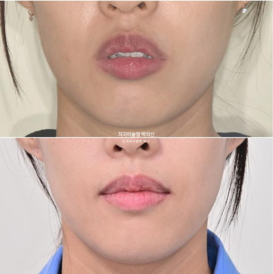 인비절라인 돌출입 발치교정 임플란트 없이 사랑니 대체 관련 이미지 25