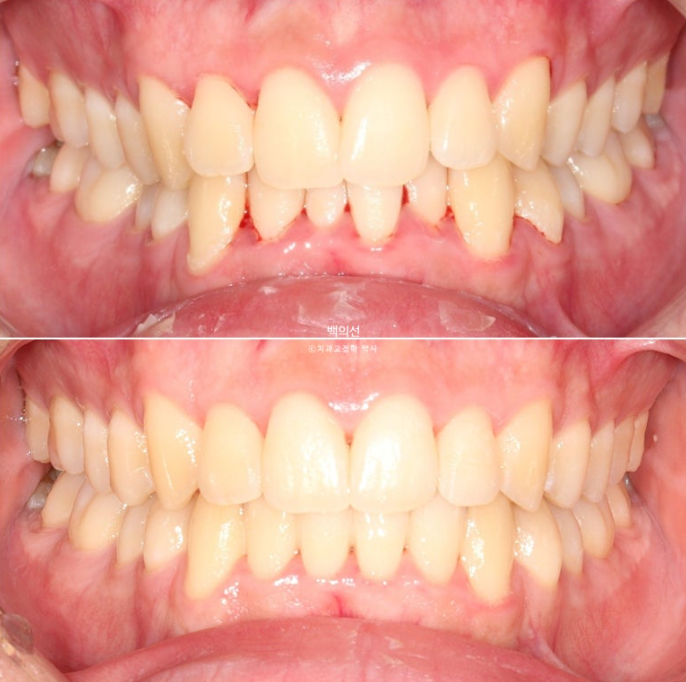 유학생 교정 인비절라인 라이트 치료기간 5개월 관련 이미지 1