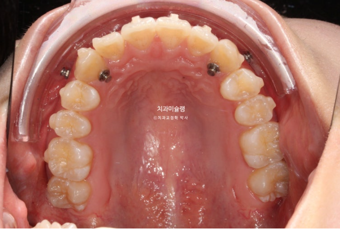덧니 인비절라인 라이트 잇몸미소 거미스마일 중심선 블랙트라이앵글 관련 이미지 9