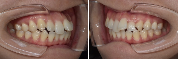 30대 돌출입 덧니 교정 인비절라인 발치교정 후기 관련 이미지 3