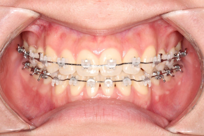 비수술 주걱턱 비대칭 발치 교정 결손치 반대교합 클리피씨 치료기간 1년 11개월 관련 이미지 9