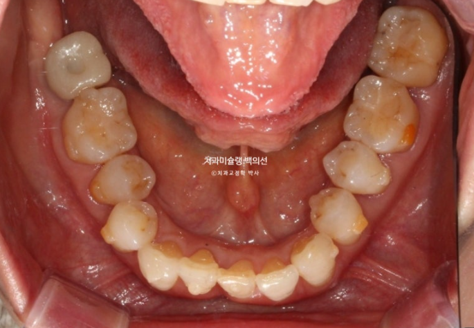 50대 치아교정 중년 발치교정 블랙트라이앵글 치료 후기 관련 이미지 11