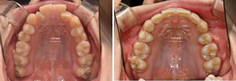 30대 인비절라인 덧니 발치교정 개방교합 치료 관련 이미지 19