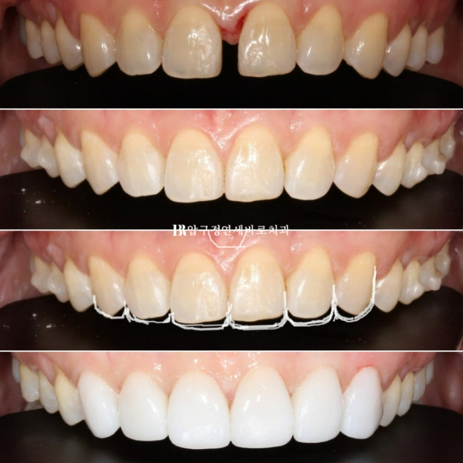 벌어진 치아 교정 인비절라인 라이트 무삭제 라미네이트 치료 관련 이미지 24
