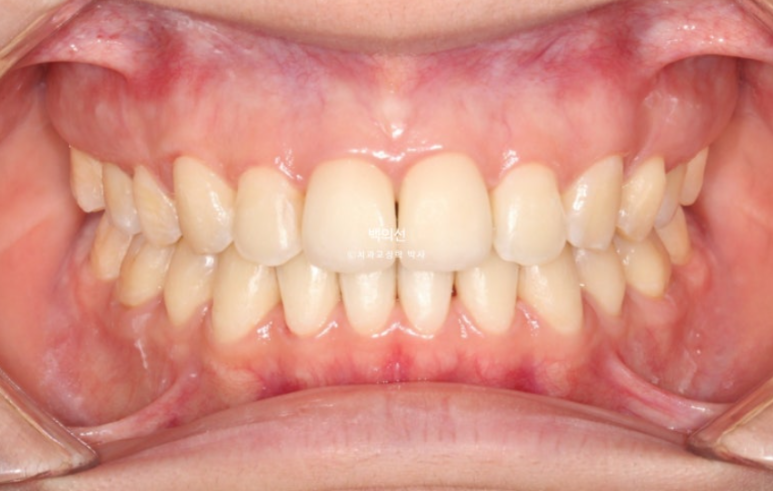 클리피씨 교정에서 인비절라인 변경 마무리 인비절라인 라이트 치료기간 4개월 관련 이미지 9