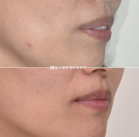 40대 돌출입 재교정, 입술부전증과 호두턱을 개선한 함입교정 증례 관련 이미지 8