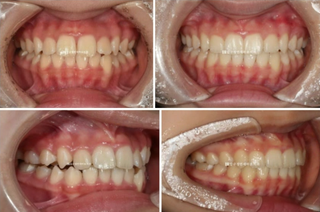 어린이 투명교정 인비절라인 틴 덧니 교정 후기 관련 이미지 12
