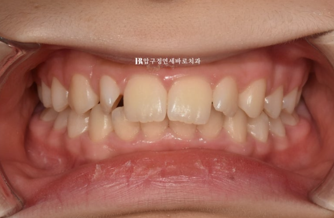 인비절라인라이트 덧니 과개교합 교정 치료기간 9개월 관련 이미지 1