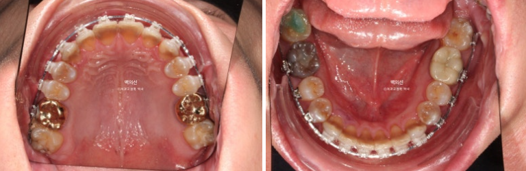Treatment Review: No-Prep Laminate for Tetracycline-Stained Teeth image 9