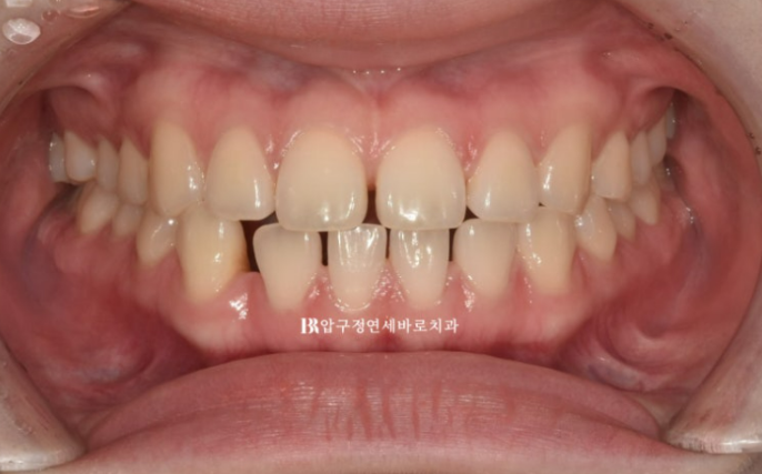 앞니 벌어짐 교정, 인비절라인이 더 잘 될까? 치아벌어짐 7개월 실제 사례 관련 이미지 1
