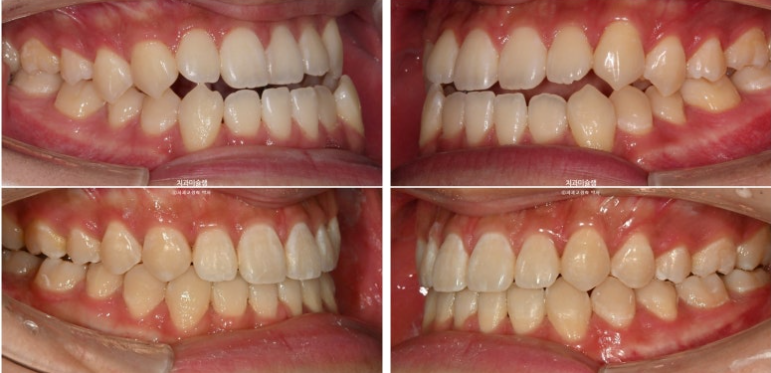 비수술 비발치 주걱턱 절충치료 클리피씨 개방교합 반대교합 치료 관련 이미지 15