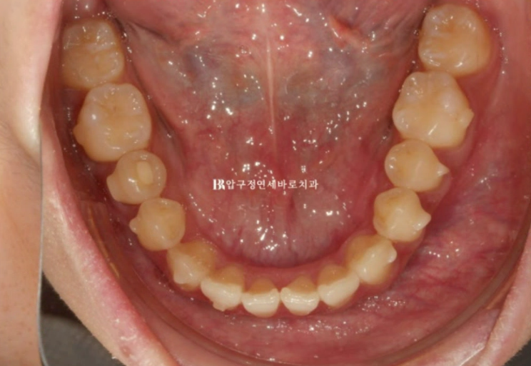인비절라인 익스프레스 토끼이빨 앞니교정 ? 관련 이미지 9