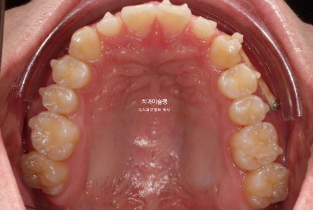 비대칭 비발치 거미스마일 잇몸미소 중심선 가위교합치료 무삭제 라미네이트 관련 이미지 12