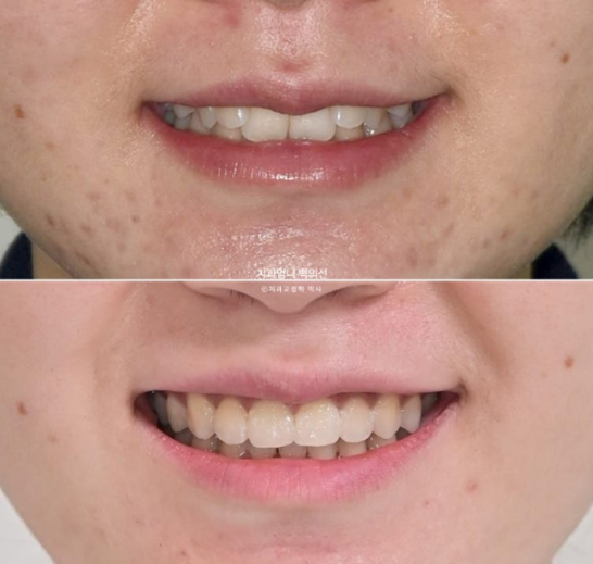 Inward-Tilted Teeth Orthodontic Treatment Review | A Real Case of Treating Congenitally Missing Lower Incisor (Three Lower Front Teeth) Without Extractions image 1
