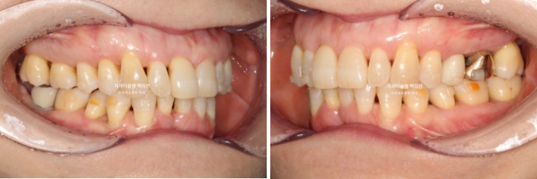 50대 치아교정 중년 발치교정 블랙트라이앵글 치료 후기 관련 이미지 9