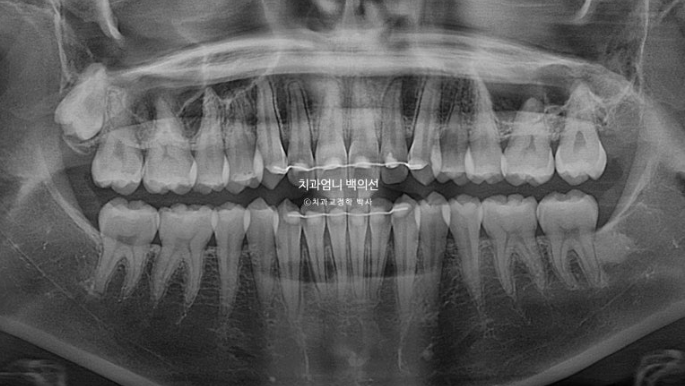 인비절라인 라이트 교정 앞니돌출 과개교합 덧니 교정 관련 이미지 13