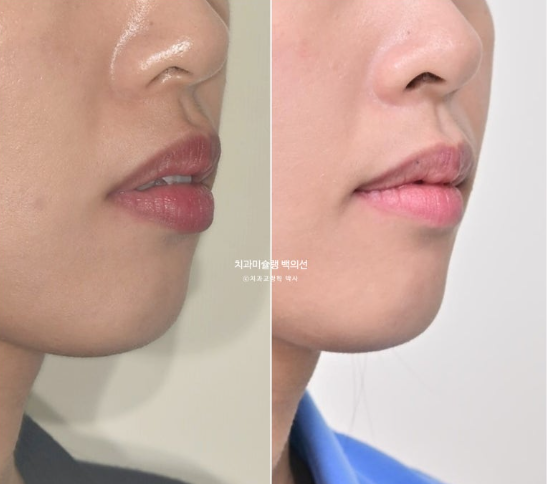 인비절라인 돌출입 발치교정 임플란트 없이 사랑니 대체 관련 이미지 26