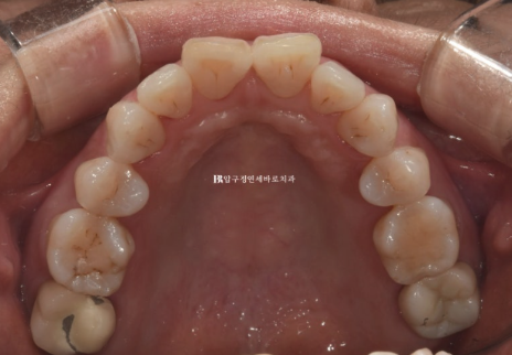 40대 50대 잇몸 약한데 교정해도 될까? 잇몸퇴축이 있는 앞니 부분교정 증례 관련 이미지 5