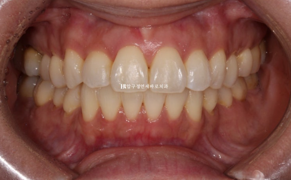 Short-Term Orthodontic Treatment Period for an Overseas Korean in Their 40s with Anterior Crossbite and Buck Teeth image 7