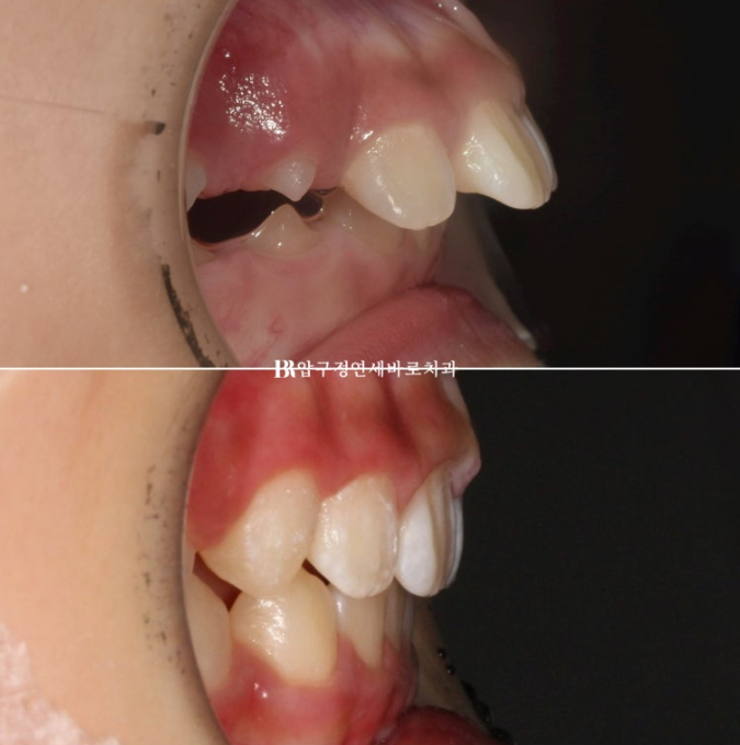 Pediatric Clear Aligners That Improved Both Deep Bite and Protruding Teeth image 17