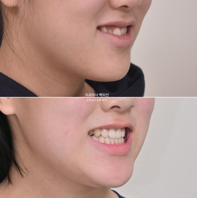 중학생 주걱턱 반대교합 개방교합 덧니 교정 인비절라인 후기 관련 이미지 13