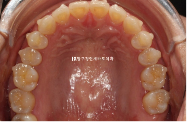 벌어진 앞니, 바로 라미네이트 하지 않은 이유｜인비절라인 후 무삭제 라미네이트 실제 사례 관련 이미지 9