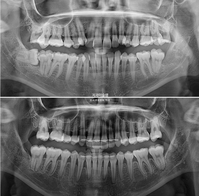 인비절라인 비발치 제2대구치 발치 사랑니 대체 교정 심한 덧니 교정 치료 관련 이미지 26