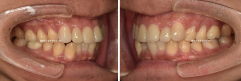 40대 중년 치아교정 인비절라인 라이트 치료기간 8개월 관련 이미지 3