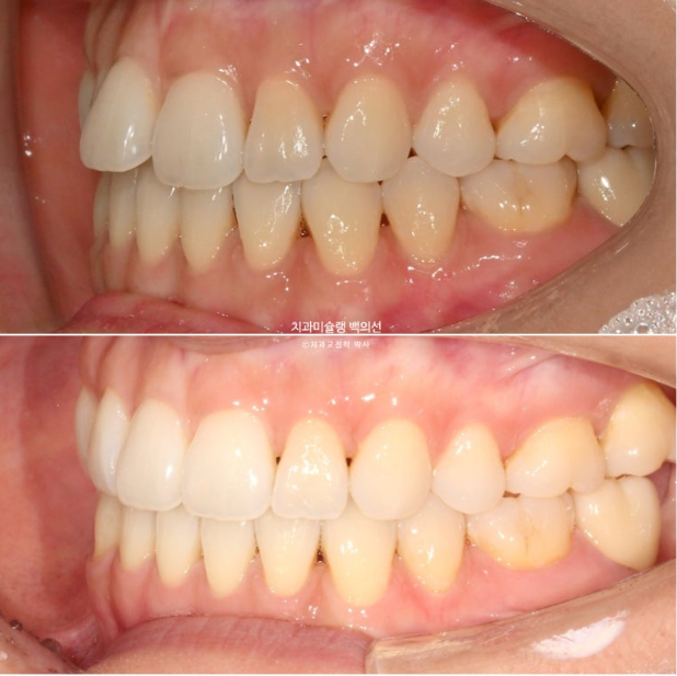 인비절라인 익스프레스 재교정 블랙트라이앵글 치간 삭제 치료기간 6개월 재제작 1회 관련 이미지 16