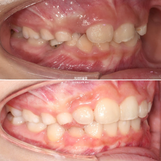 어린이 투명교정 인비절라인 퍼스트 과개교합 교정 후기 관련 이미지 19