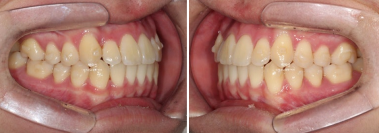 유학생 교정 덧니 반대교합 인비절라인 라이트 치료기간 관련 이미지 8