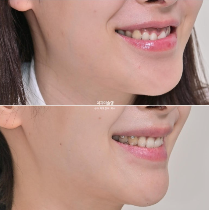 선수술 양악수술 비대칭 주걱턱 잇몸미소 치료 인비절라인 라이트 관련 이미지 12