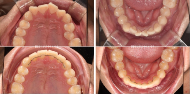 인비절라인 라이트 교정 덧니 이소맹출 반대교합 관련 이미지 11
