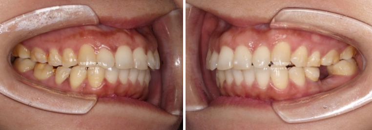 40대 인비절라인 라이트 앞니 벌어짐 뻗침 돌출 치료 관련 이미지 8