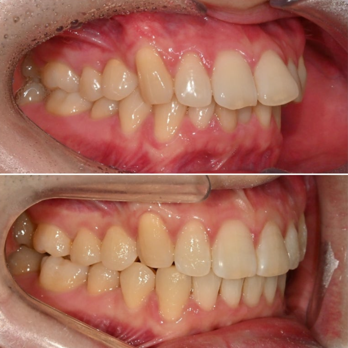 인비절라인 라이트 돌출 과개교합 중심선 교정 치간삭제 치료기간 관련 이미지 14