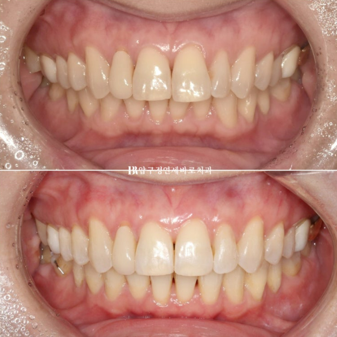 Invisalign Lite for Orthodontic Treatment in Your 40s: Crossbite and Protrusive Mouth Correction image 17