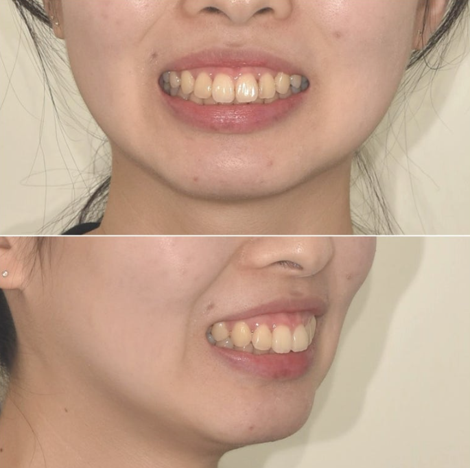 돌출입 인비절라인 발치교정 거미스마일 잇몸미소 잇몸돌출 입술부전증 무턱 재교정 관련 이미지 6