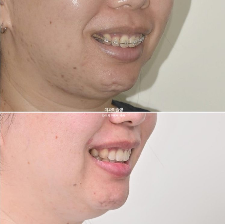 Extraction Orthodontics with Clippy-C for Protruding Mouth, Gum Smile, Gummy Smile Correction, and Treatment for a Recessed Chin image 1
