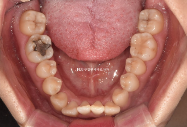Invisalign Success Depends on Wearing Them Consistently|9-Month Real Treatment Case of Crowding & Underbite image 5