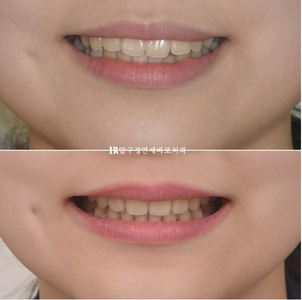 인비절라인 돌출입 발치교정, 정말 결과가 안 좋을까요? 관련 이미지 18
