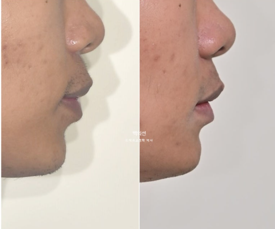 거미스마일 잇몸미소 발치 돌출입 과개교합 교정 후기 관련 이미지 16