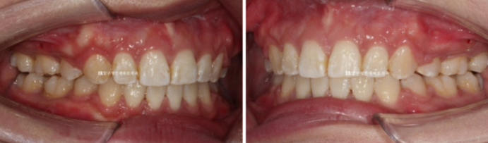 How Do the Buccal Corridors and Smile Line Change After Extraction Treatment for Protruding Teeth?|An Orthodontic Case That Also Improved Lip Incompetence image 10
