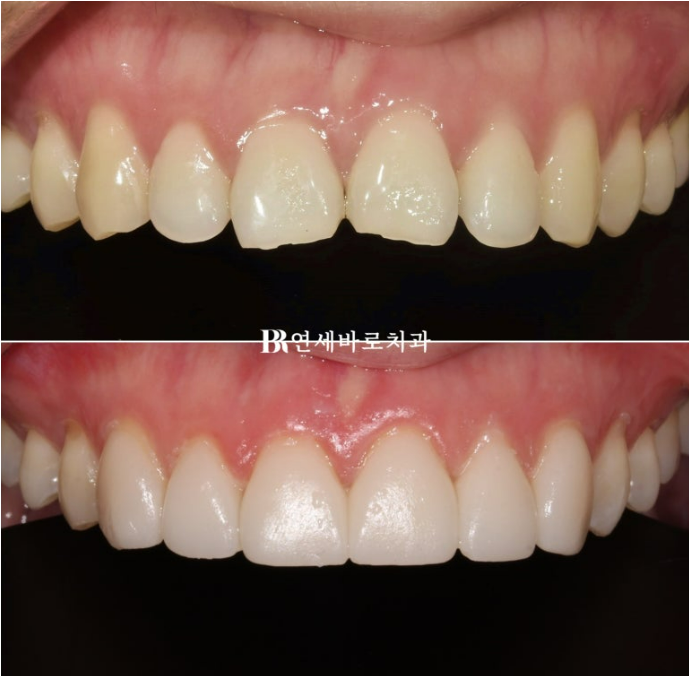 No-Prep Veneers Are Not the Right Treatment for Everyone image 5