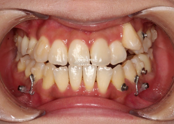 비발치 교정 덧니 인비절라인 교정 절단교합 반대교합 치료기간 1년 6개월 관련 이미지 9