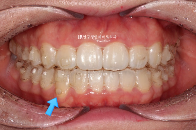 인비절라인 라이트 과개교합 반대교합 돌출입 뻐드렁니 교정 치료 관련 이미지 10