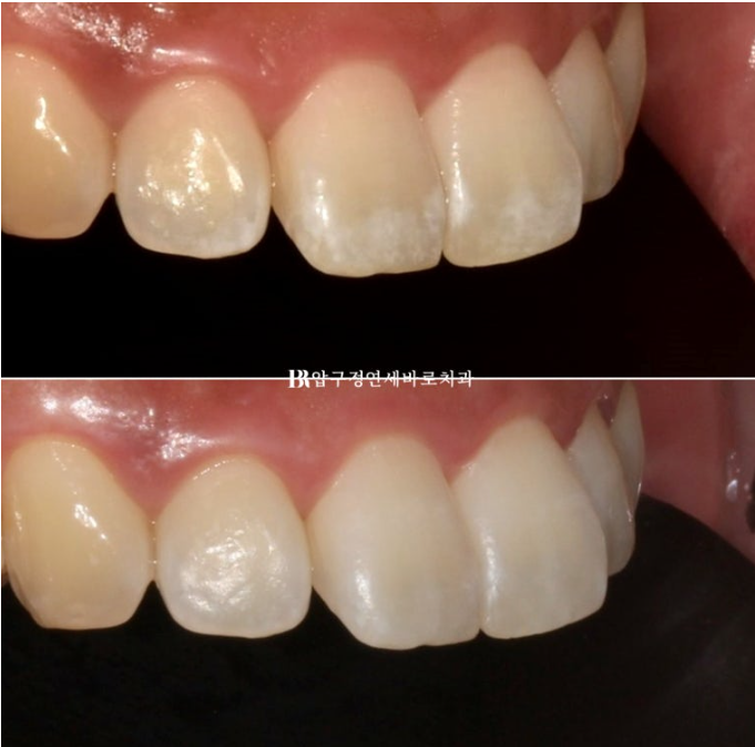 치아 흰 반점, 갈지 않고 치료할 수 있을까요? 아이콘(Resin Infiltration) 실제 사례 관련 이미지 3