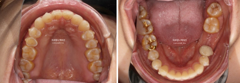 40대 인비절라인 라이트 앞니 벌어짐 뻗침 돌출 치료 관련 이미지 9