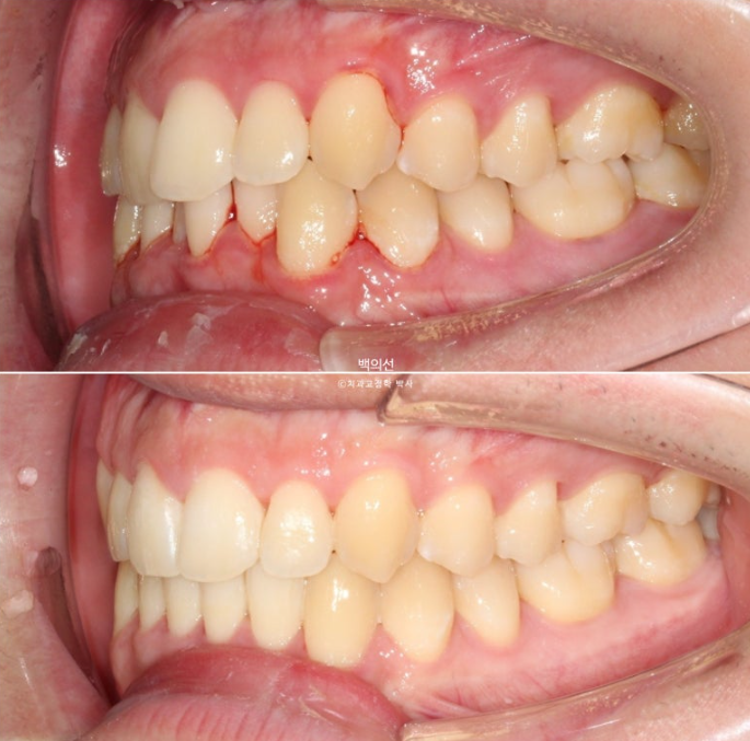 유학생 교정 인비절라인 라이트 치료기간 5개월 관련 이미지 15